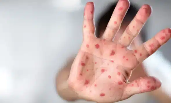 rubella, varicela, polio, sífilis, tuberculose, hepatites, meningite, tetano, difteria, vacina
