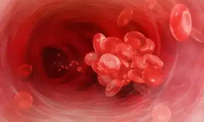 anemia-precirúrgica, anemia-ferropriva